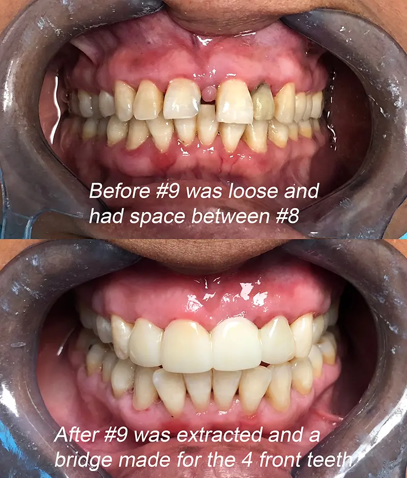 Dental Bridge Cases 3